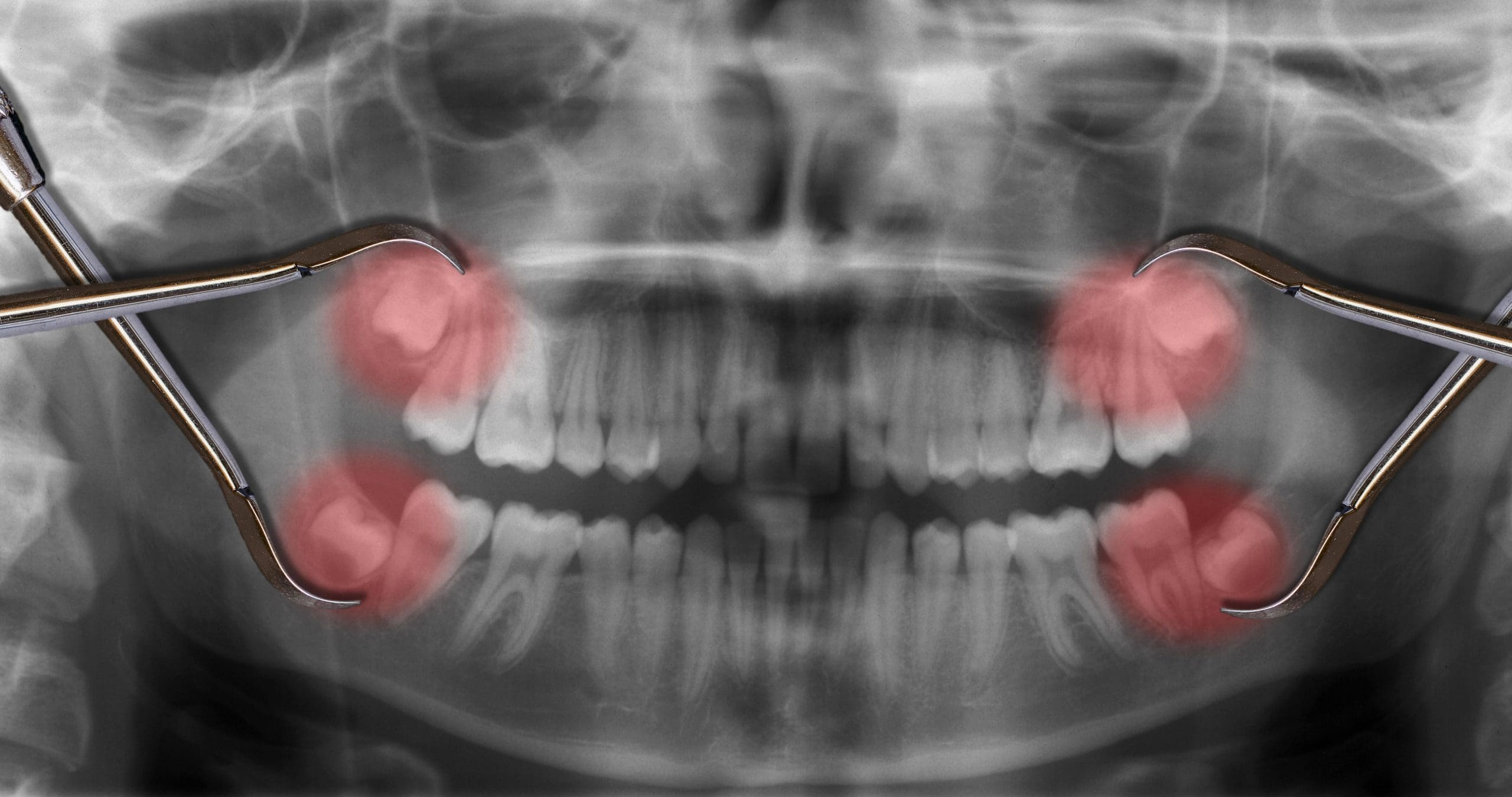 Endodontic Treatment for Trauma: Restoring Teeth After Injury