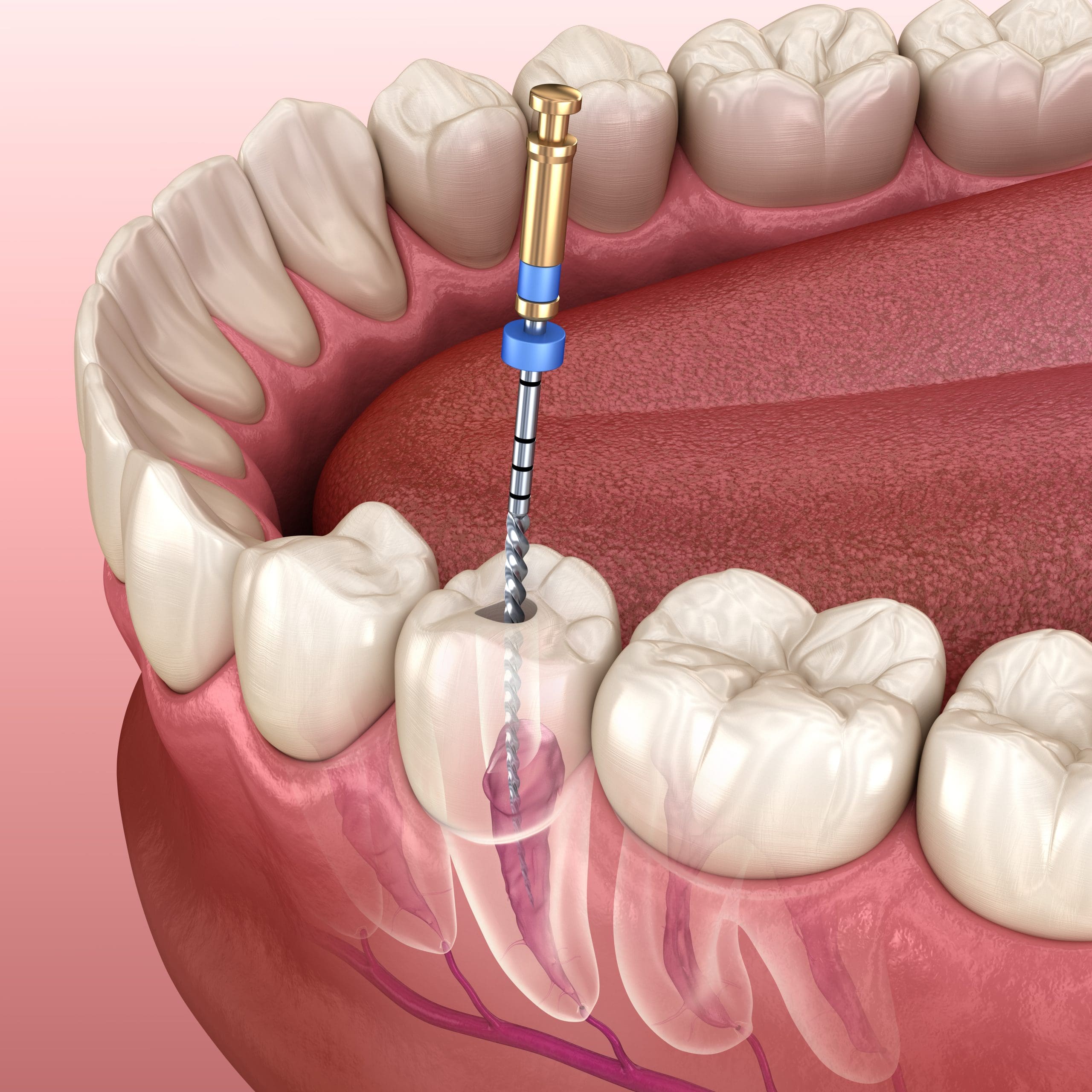 Emergency Endodontic Treatment: Fast Relief When Every Minute Counts
