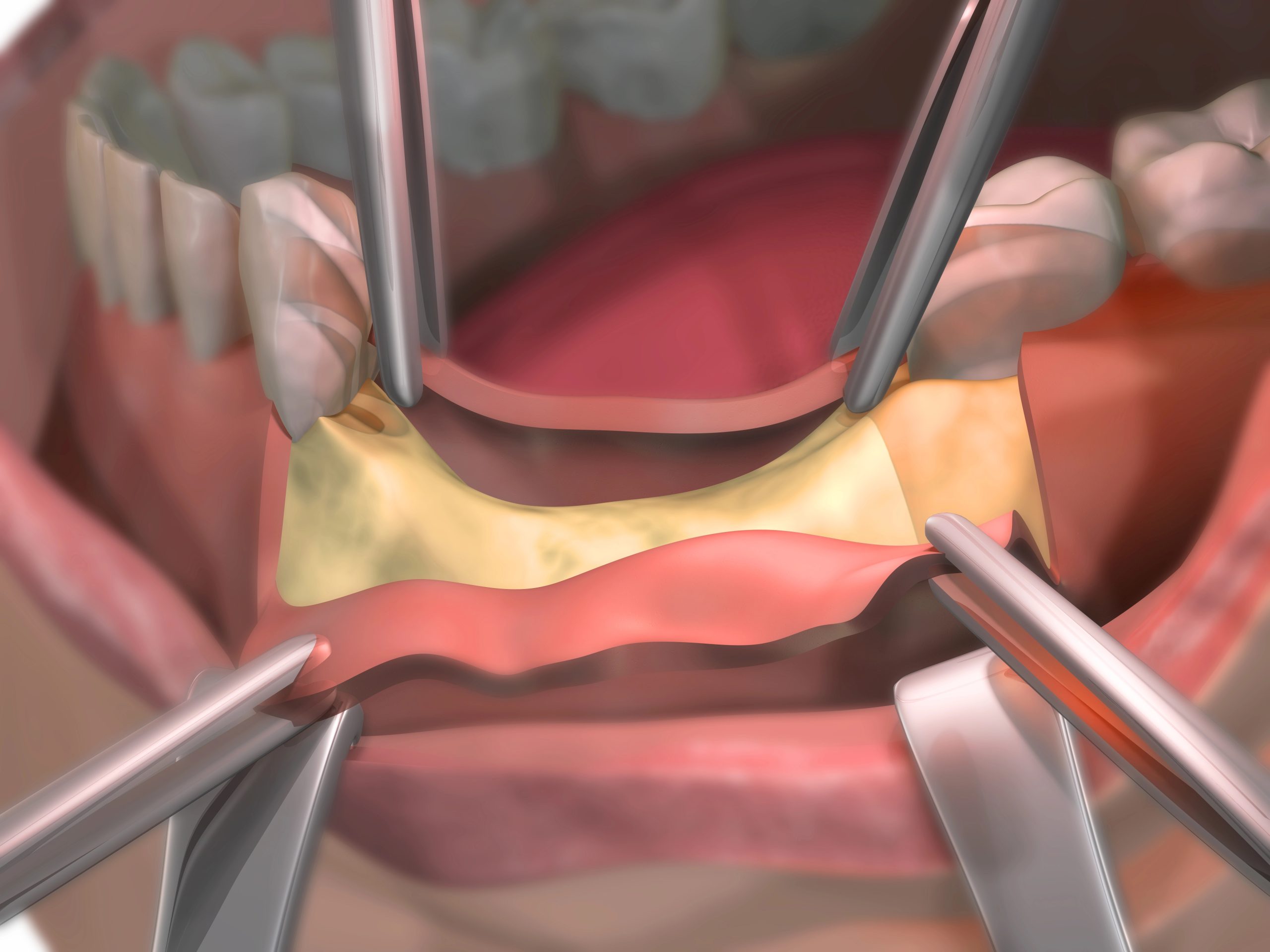Bone Grafting After Tooth Extraction: Why It’s Sometimes Necessary
