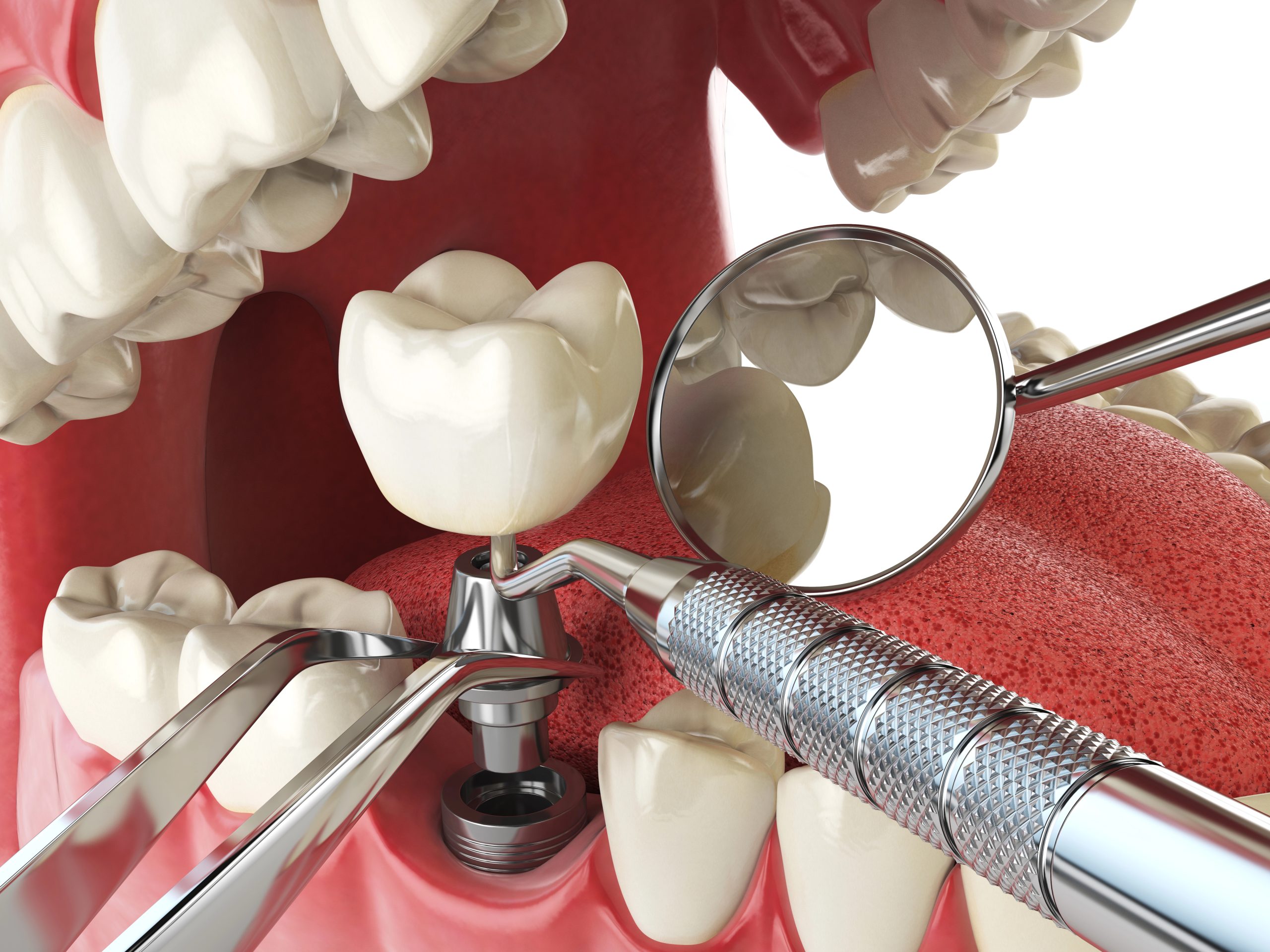 Affordable Dental Implant Near Me: How to Restore Your Smile Without Overspending