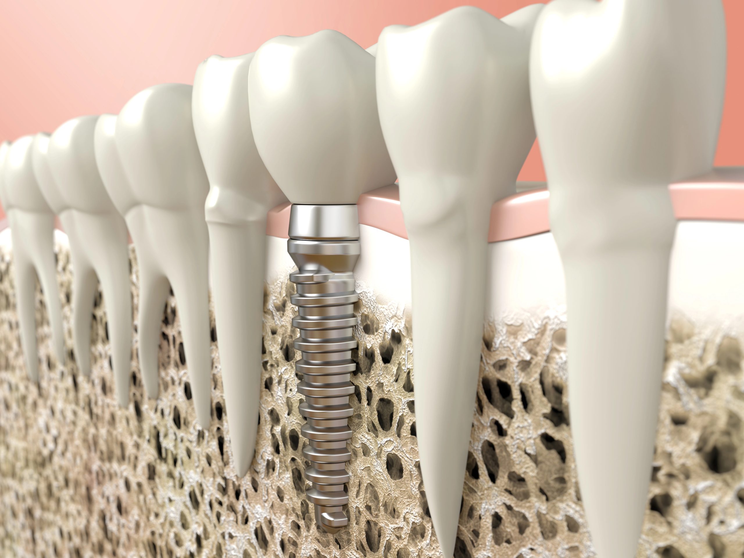 Dental Implant for Single Tooth: A Strong and Natural-Looking Solution