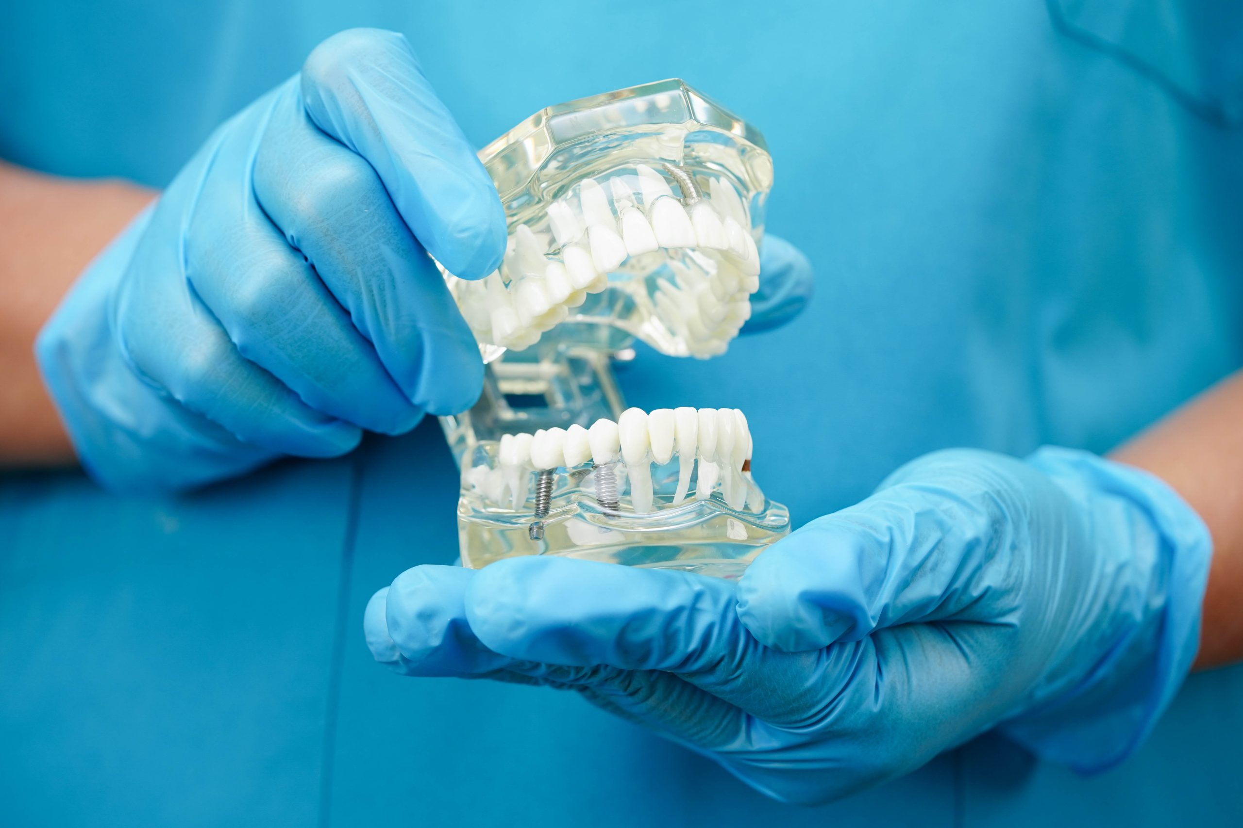 Dental Implant vs Bridge: Which Tooth Replacement Option Is Better?