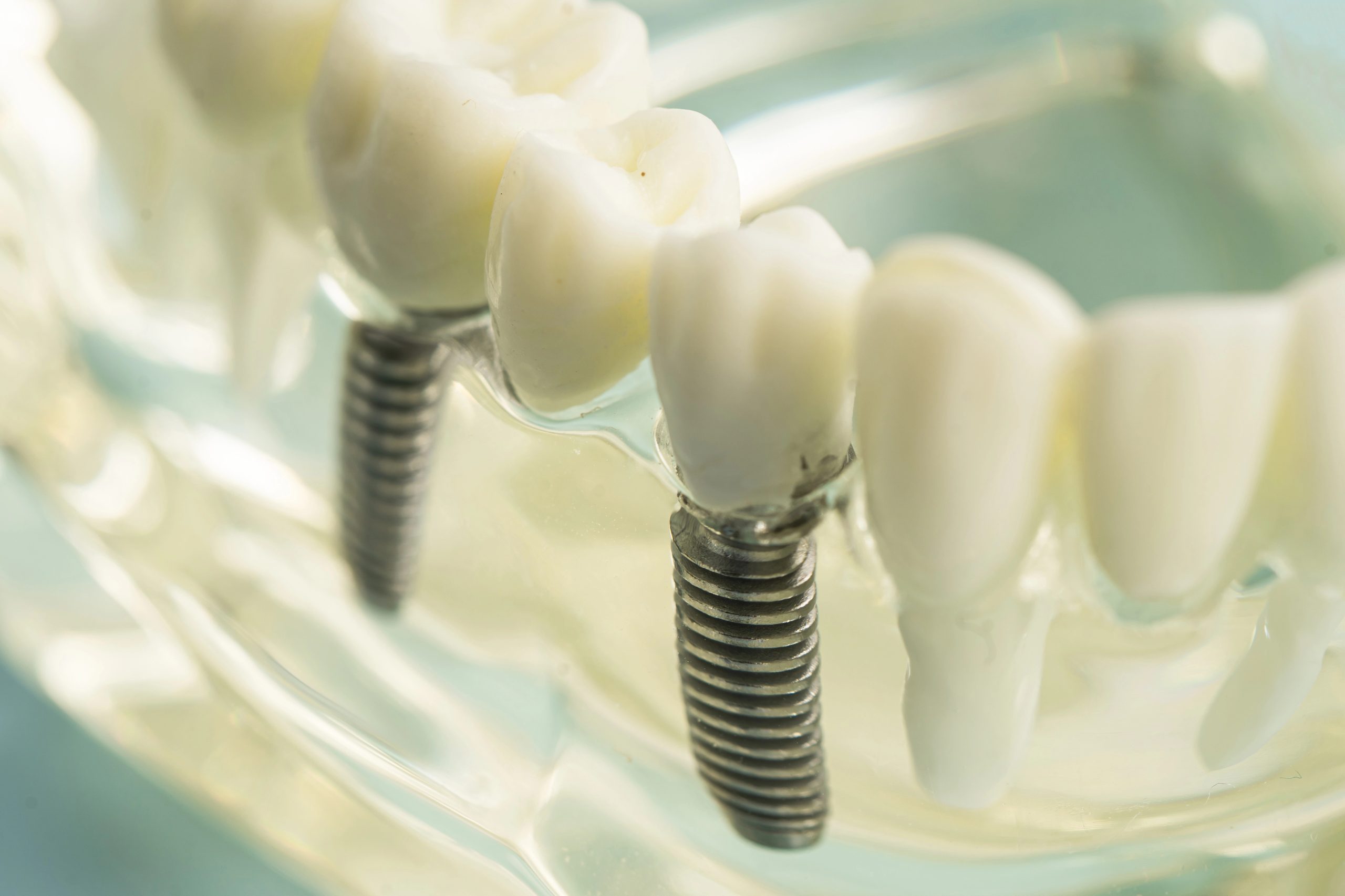 Dental Implant for Front Tooth: Achieve a Seamless and Confident Smile