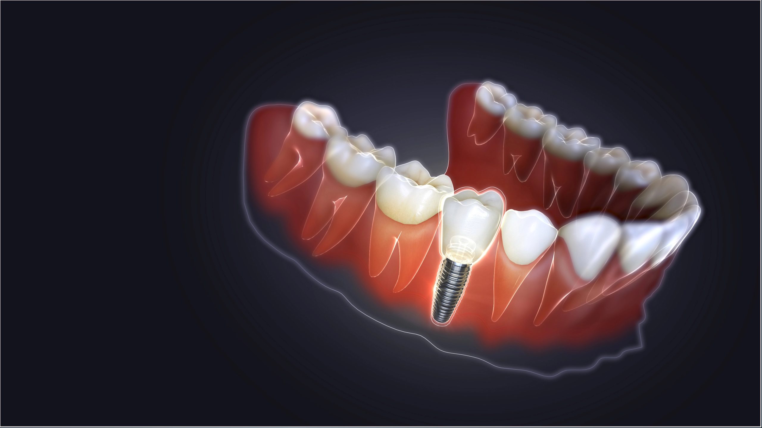Dental Implant with Same Day Crown: Fast and Effective Tooth Replacement