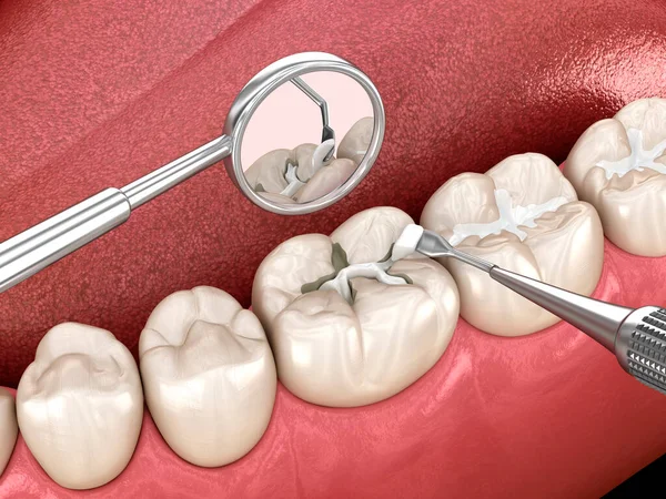 5 Essential Tips for Maintaining Dental Sealants for Longevity