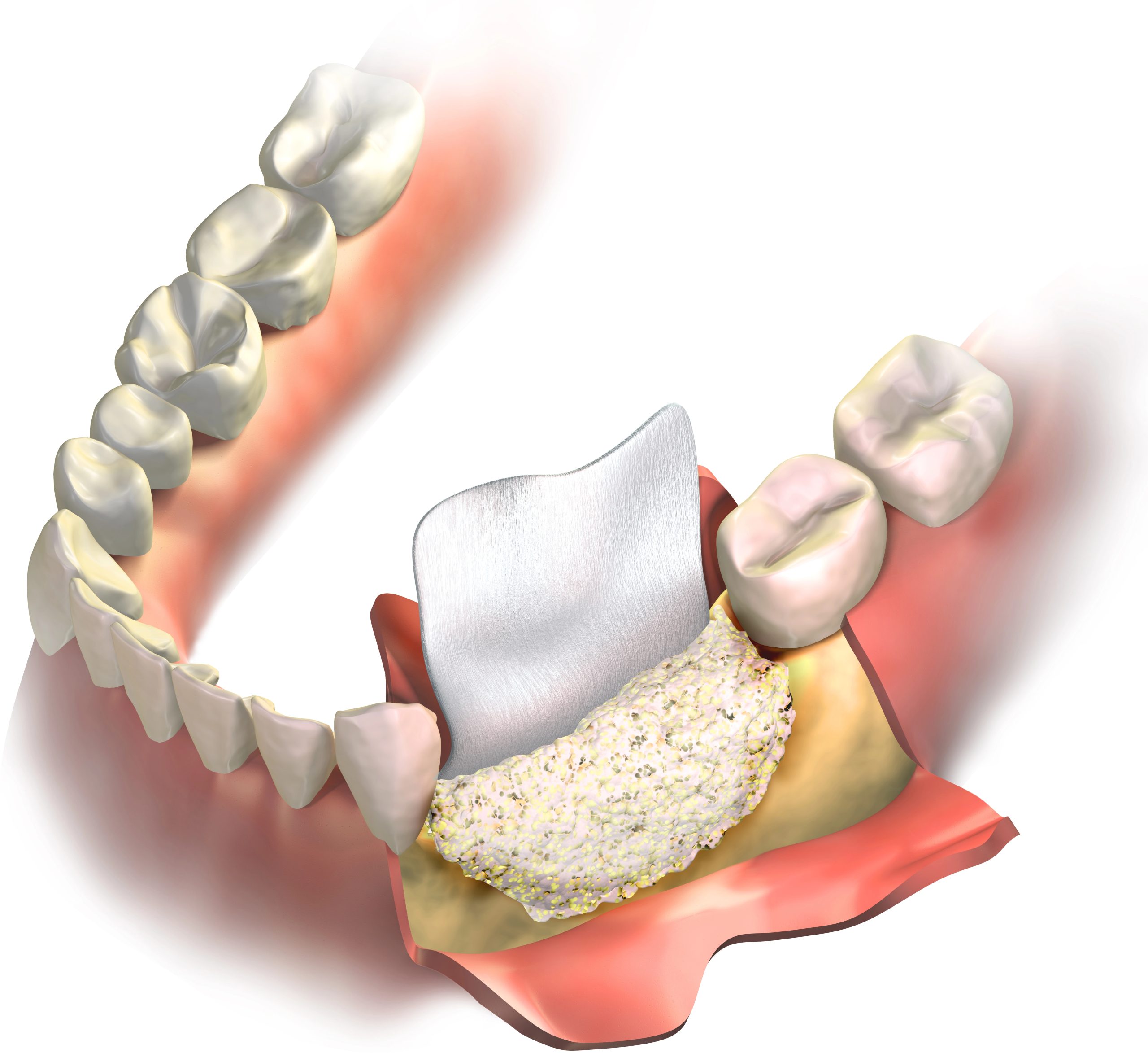 Bone Grafting in Yorba Linda CA for Restoring Jawbone Health and Implant Readiness at Dentique Dental Studio
