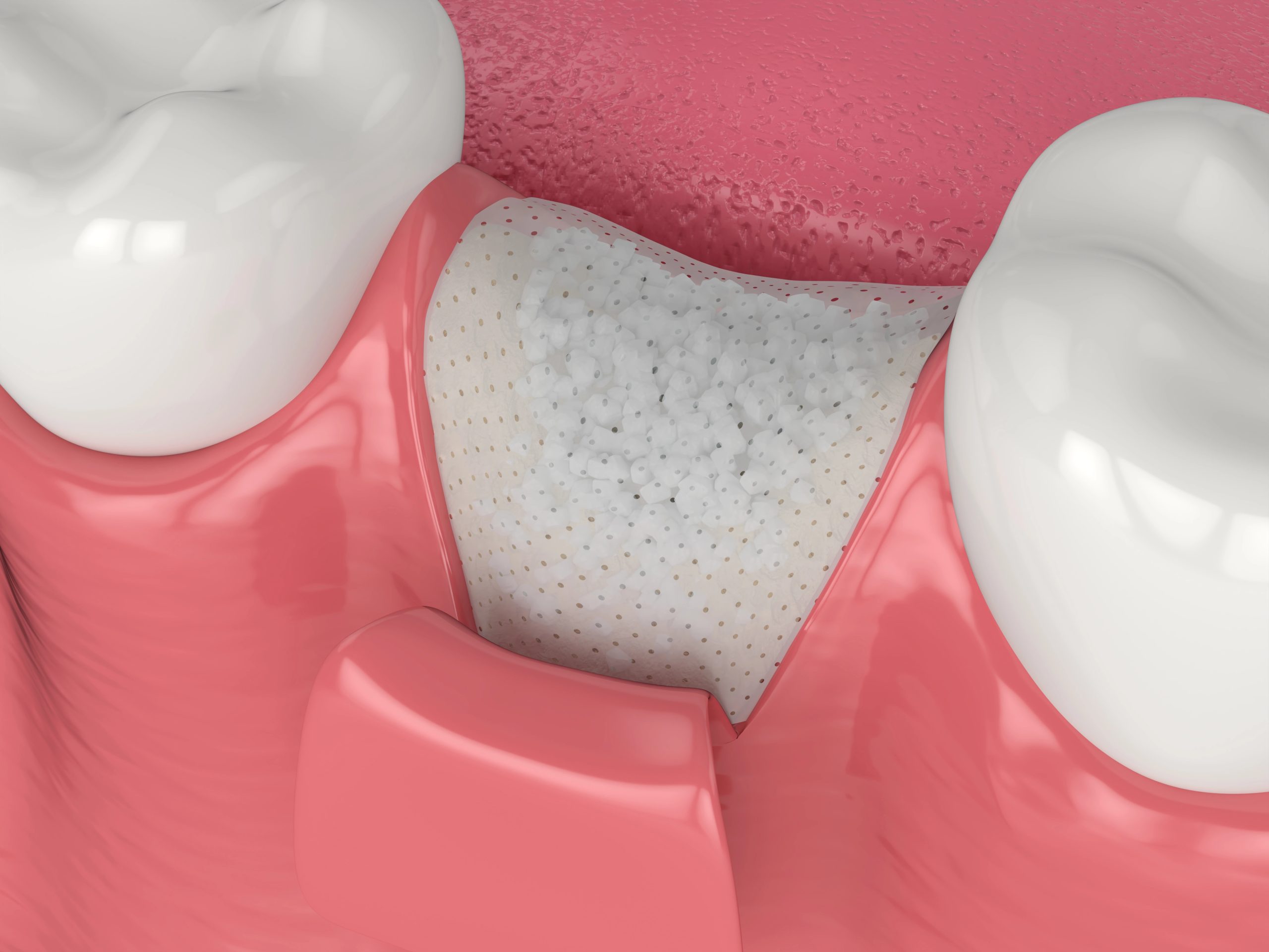 Understanding Bone Grafting Importance for Dental Implants in Yorba Linda CA to Prevent Bone Loss and Enhance Success Rates