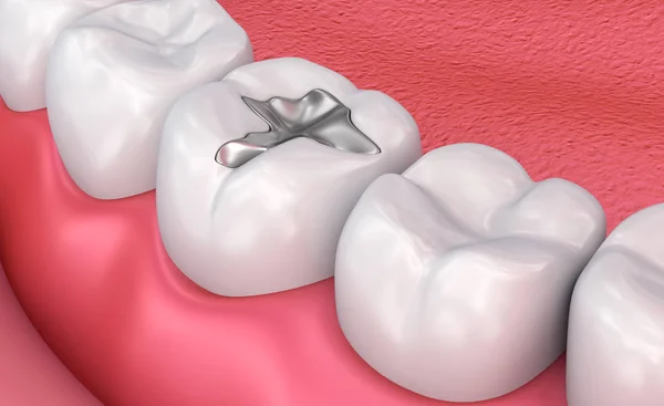 How Do Porcelain Inlays and Onlays Compare to Traditional Fillings for Long-Term Results?