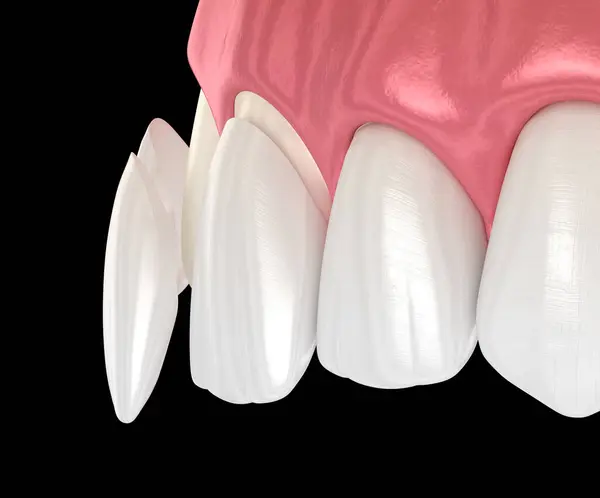How Long Do Dental Veneers Last? What Yorba Linda, CA Patients Should Know