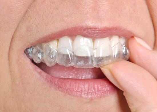 Invisalign-Fullerton Dentist